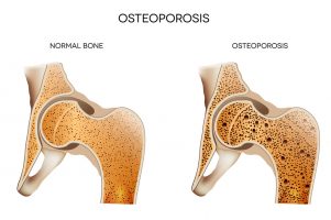 Home Care Services Massapequa NY - Caring for a Parent with Osteoporosis